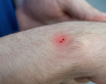 First-Aid 101: Animal Scratches and Bites
