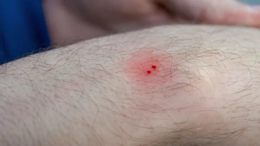 First-Aid 101: Animal Scratches and Bites