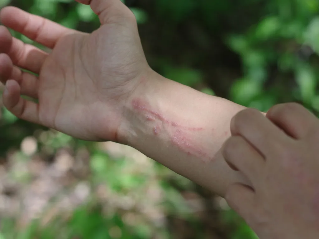 First-Aid 101: Poison Ivy Rash
